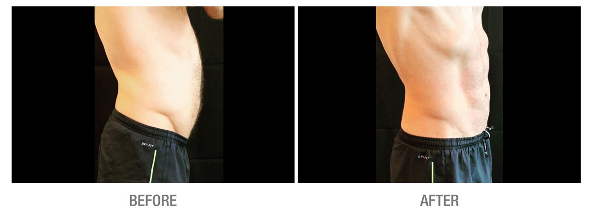 Body sculpting with Emsculpt before and after